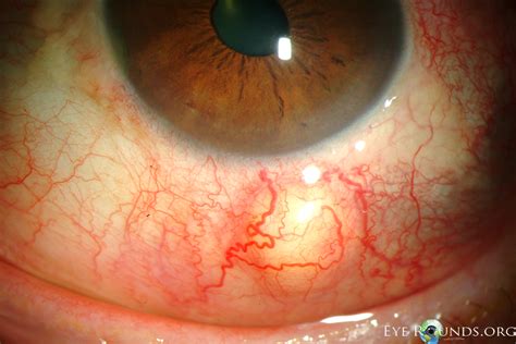 Atlas Entry - Nodular anterior scleritis