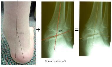 Valgus Vs Varus Of Ankle