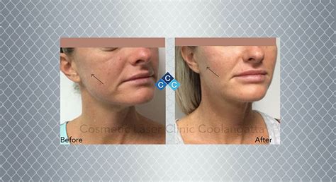 Mid Face Lift and Cheek Enhancements for Women Gold Coast