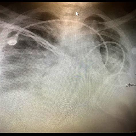 Chest X-radiograph in a case of acute fibrinous organizing pneumonia... | Download Scientific ...