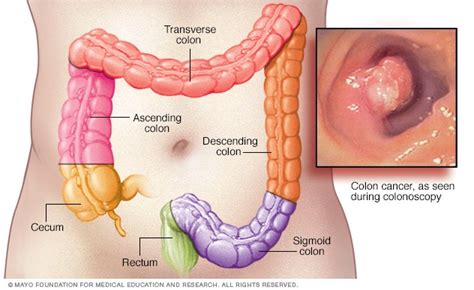 Cancer En El Colon Sintomas - SEO POSITIVO