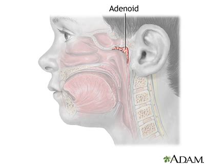 Adenoid removal Information | Mount Sinai - New York