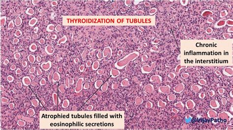 Chronic Pyelonephritis Histology