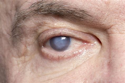 Cataract Symptoms - Monterey, CA - Monterey County Eye Associates