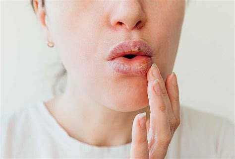 Lip Allergy: Cause, Symptoms, Treatment and Prevention of Lip Allergy