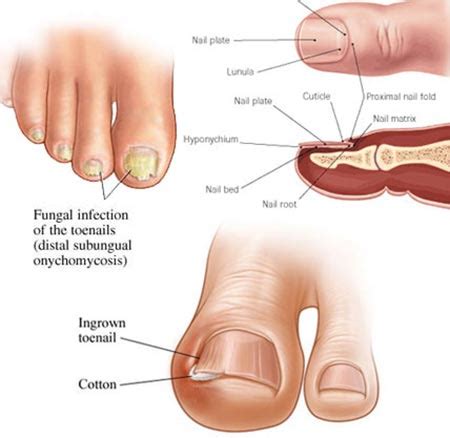 Toenail Fungus Treatment · 2018 Top Foot Doctor, Podiatrist ·NYC