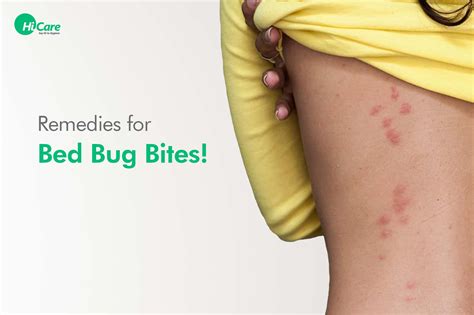 How to Treat Bed Bugs Bites?