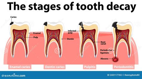 The Stages Of Tooth Decay Infographic. Dental Toothache Symbol Vector ...