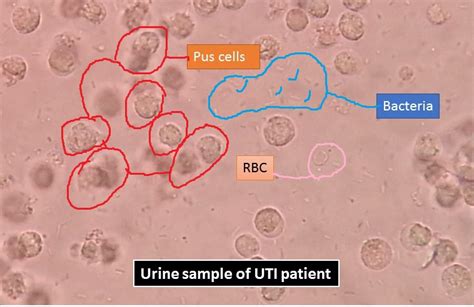 Microbiology Urine Culture