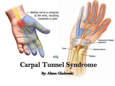 Carpal Tunnel Syndrome Diagnosis Criteria