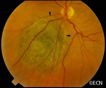 Choroidal Melanoma » New York Eye Cancer Center