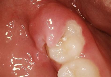 Wisdom Tooth Infection - Symptoms, Causes, Treatment, Pictures