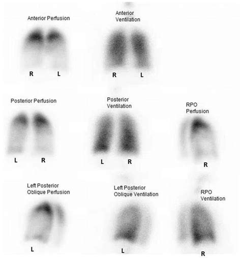 Lung Perfusion Scan