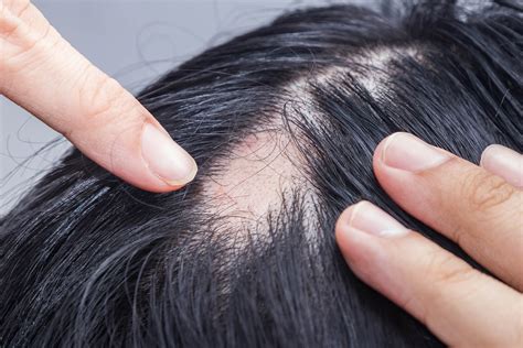 Alopecia Areata - Treatment | Dr Therianou Therianou MD, PhD