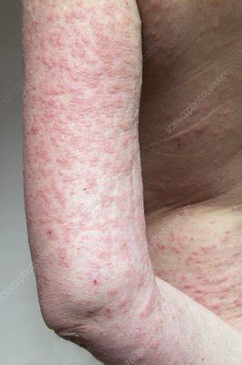 Sun rash - Stock Image - C009/6349 - Science Photo Library