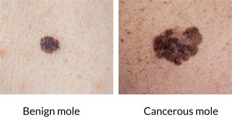 Pictures Melanoma Skin Cancer Moles