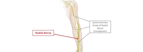 Radial Nerve Entrapment - Ilyas Munshi, M.D.