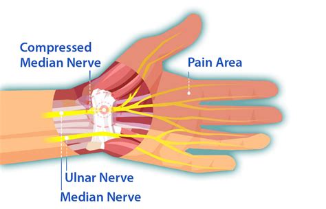 Carpal Tunnel: Symptoms & Treatments - Neurology Office Joseph Kandel M.D.