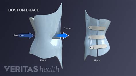 Types of Scoliosis Braces