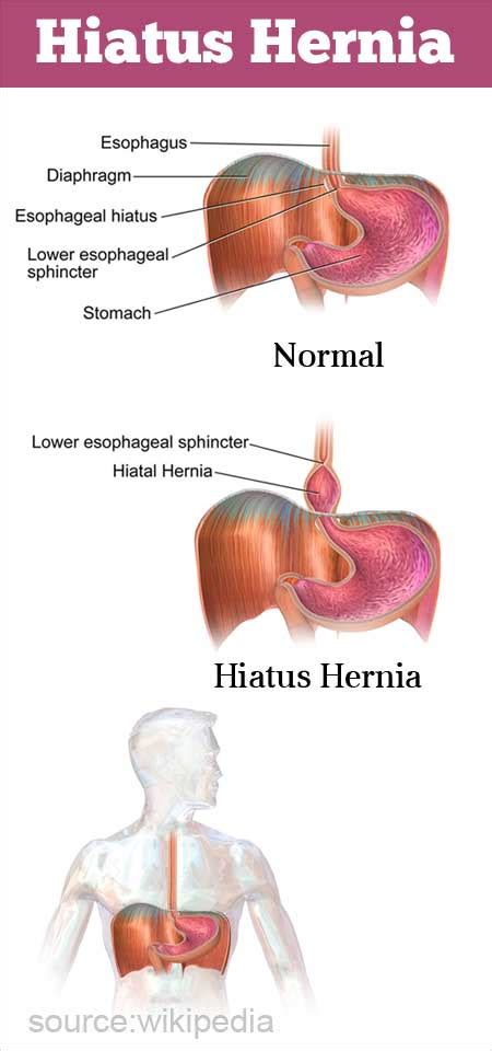 Hiatus Hernia Types, Causes, Symptoms, Complications,, 47% OFF