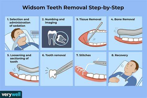 Wisdom Teeth Removal: What to Expect, Recovery, and More