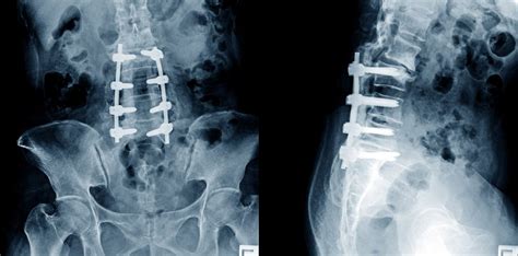 Lumbar Spinal Fusion Surgery - Brain & Spine Surgeons of New York