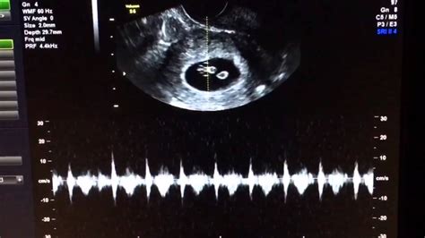 Fetal heartbeat doppler - sonryte