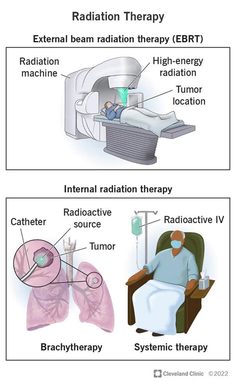 Cancer Treatment Options: Surgery, Radiation, And Chemotherapy - Ask The Nurse Expert