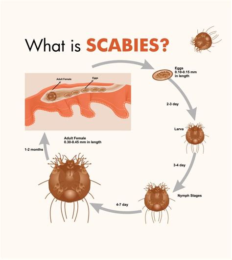 Scabies In Kids: Causes, Symptoms, Diagnosis And Treatment