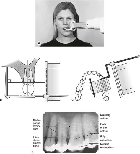 periapical x ray techniques - fashiondesignforbeginnersstepbystep