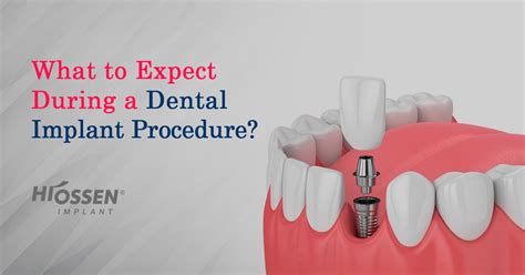 What to Expect During a Dental Implant Procedure | Hiossen