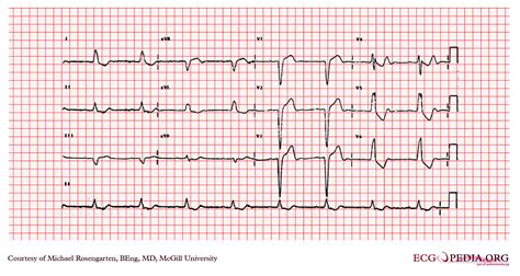 Left bundle branch block EKG examples - wikidoc