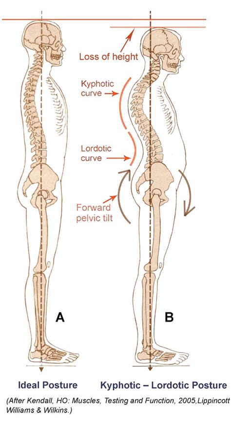 Swayback Posture: Symptoms, Causes, and Treatment Options - Chiropractic Scientists | 915-850-0900