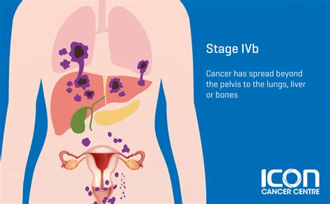 Cervical Cancer Stages