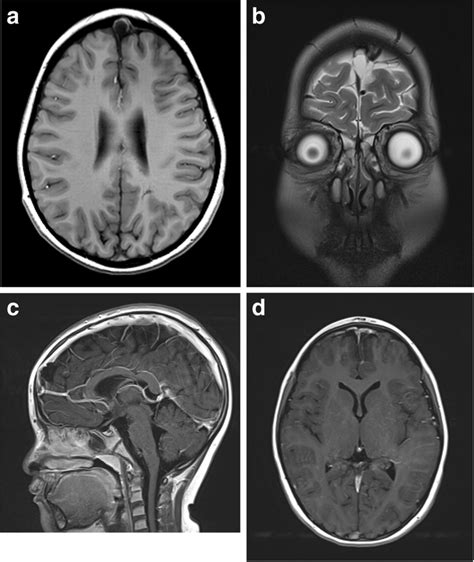 Magnetic resonance imaging (MRI) findings of giant arachnoid... | Download Scientific Diagram