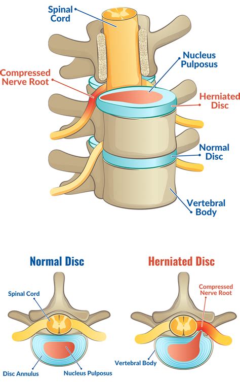 5 Unexpected Symptoms of a Herniated Disc | CORE Orthopedics