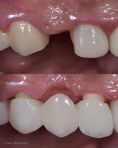 Ovate pontic for the correct emergence profile.. A clinical case | Dental Esthetics