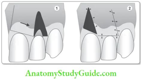 Mucogingival Surgery Question And Answers - Anatomy Study Guide