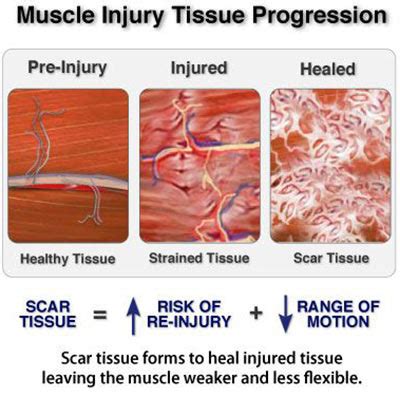 Pulled Back Muscle Treatment in New York City