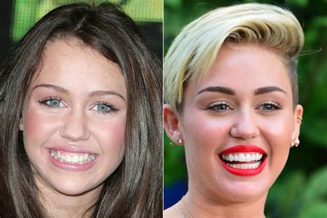 Miley Cyrus Dental Veneers Transformation - Destination Smile