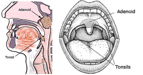 Adenoid Nose