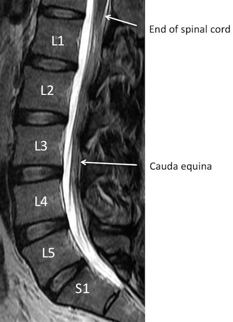 Lumbar Spine Mri Labeled