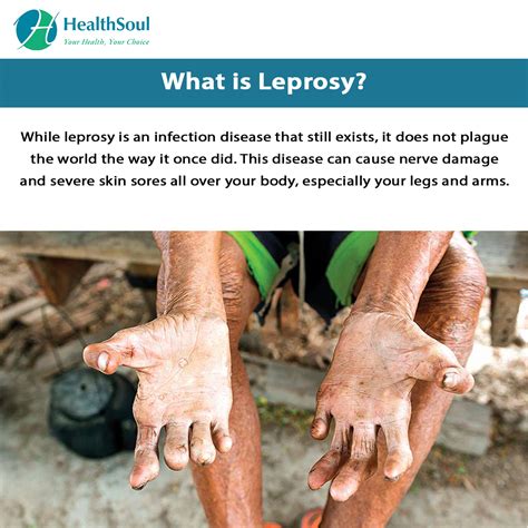 Leprosy: Symptoms and Treatment – Healthsoul