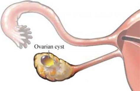 What You Can Expect If an Ovarian Cyst Bursts | HubPages