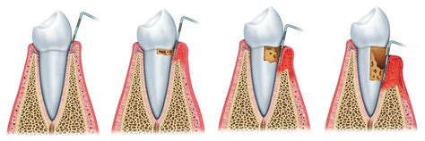 What are the Stages of Periodontal Disease? - IMPLANT PERIO CENTER