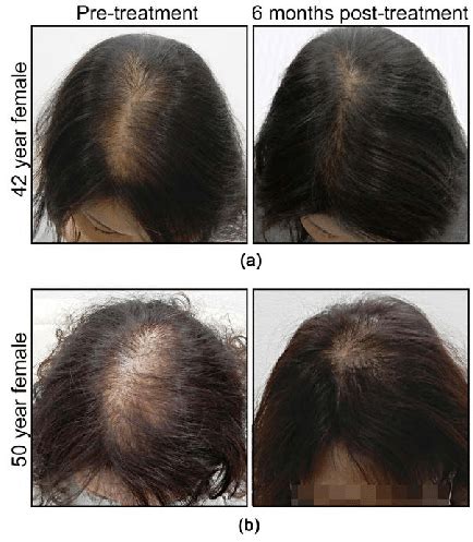 Representative photographs of hair re-growth, before and after... | Download Scientific Diagram