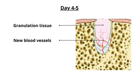 The different healing stages after a tooth extraction (with pictures)