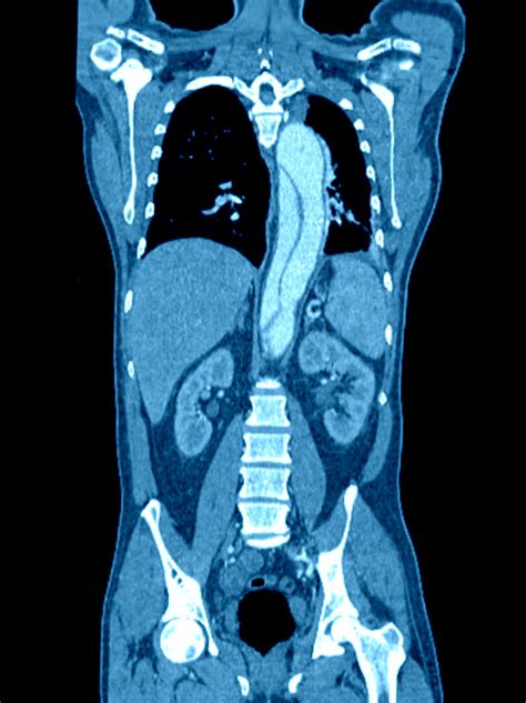 IV contrast for CT is not associated with increased risk of acute kidney injury