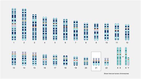 Down Syndrome (Trisomy 21)