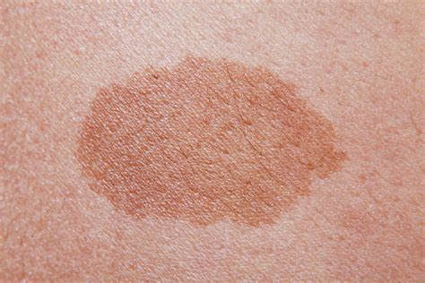 Birthmarks: Causes, types, and treatments